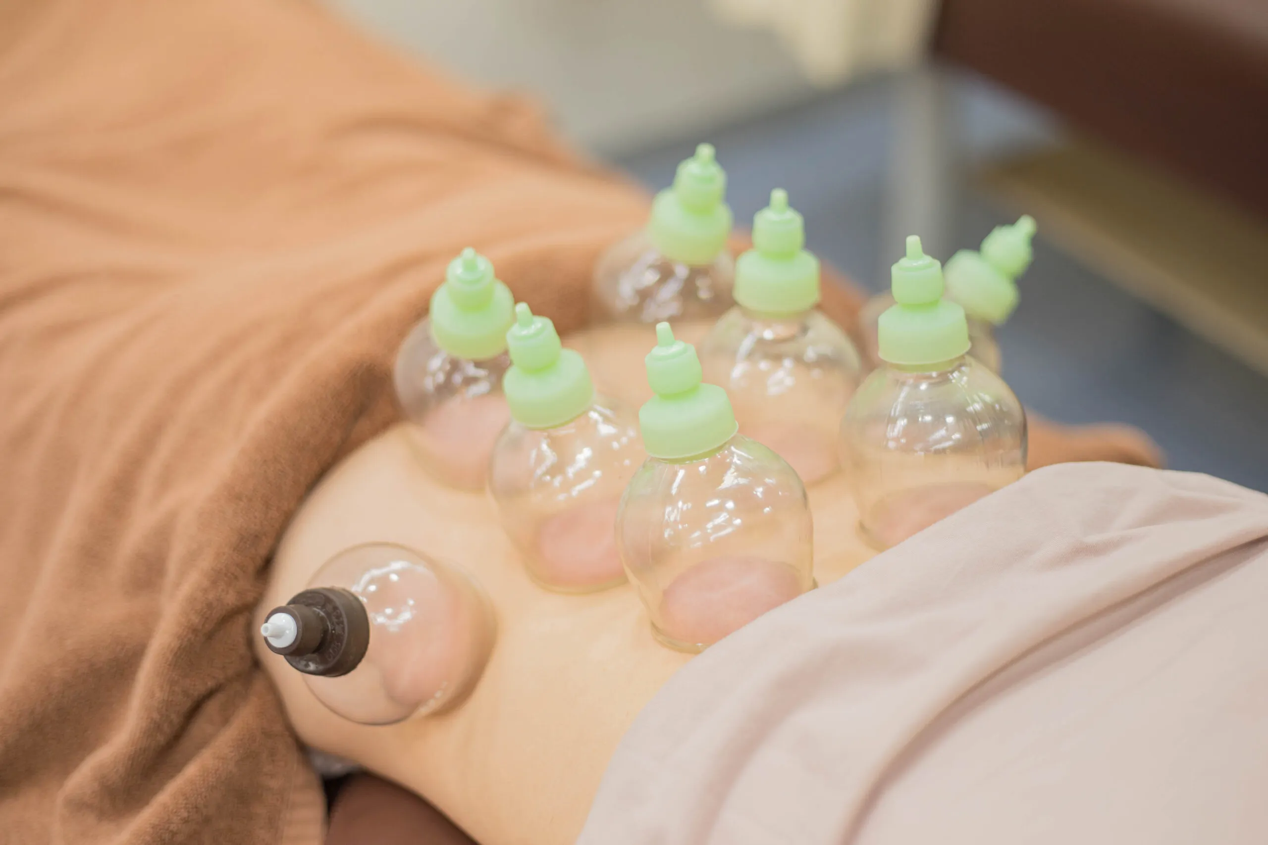 阿佐ヶ谷中央整骨院でのカッピング施術の様子